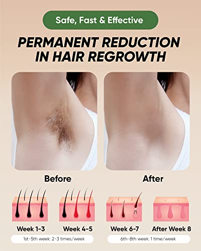 XSOUL IPL Hair Removal for All Body Parts
